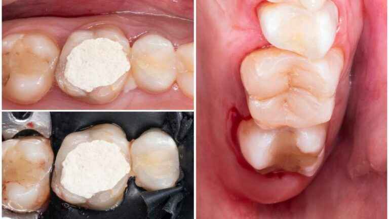 qual a diferença entre restauração e obturação