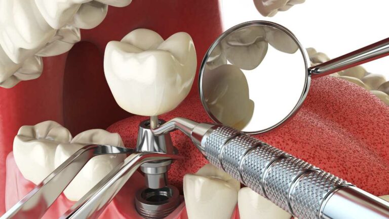 o que é mini implante dentário